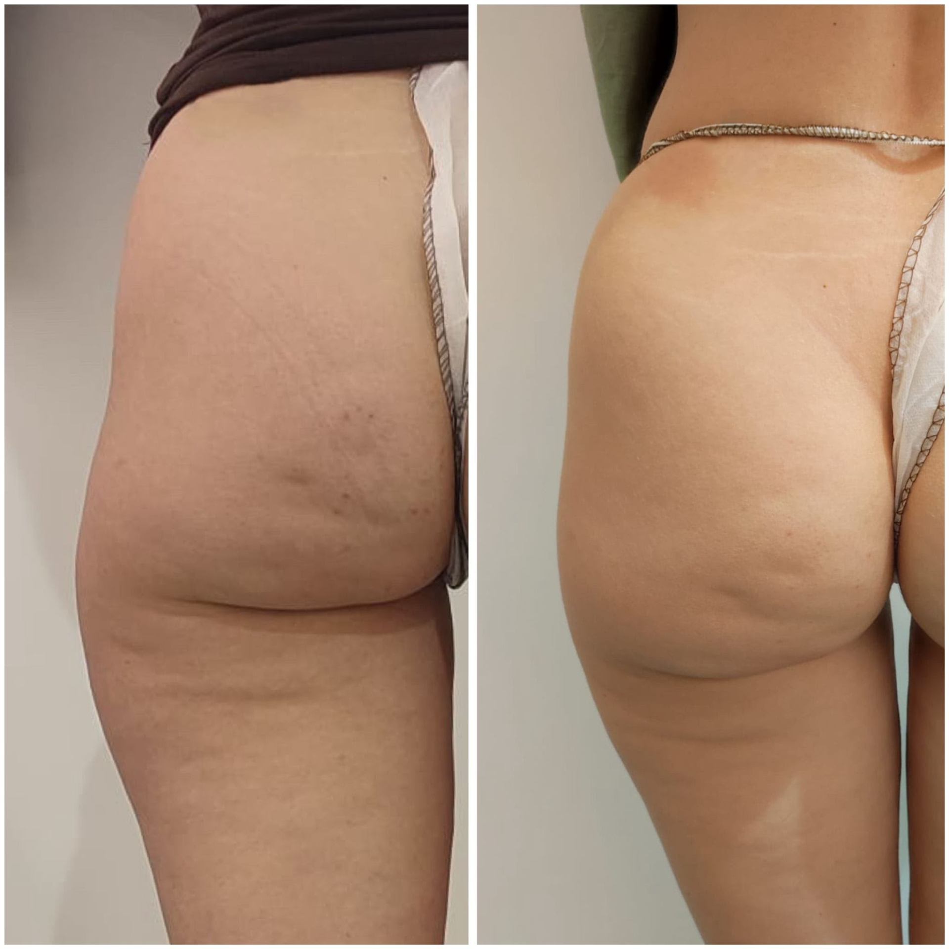 Trattamento corpo glutei prima e dopo