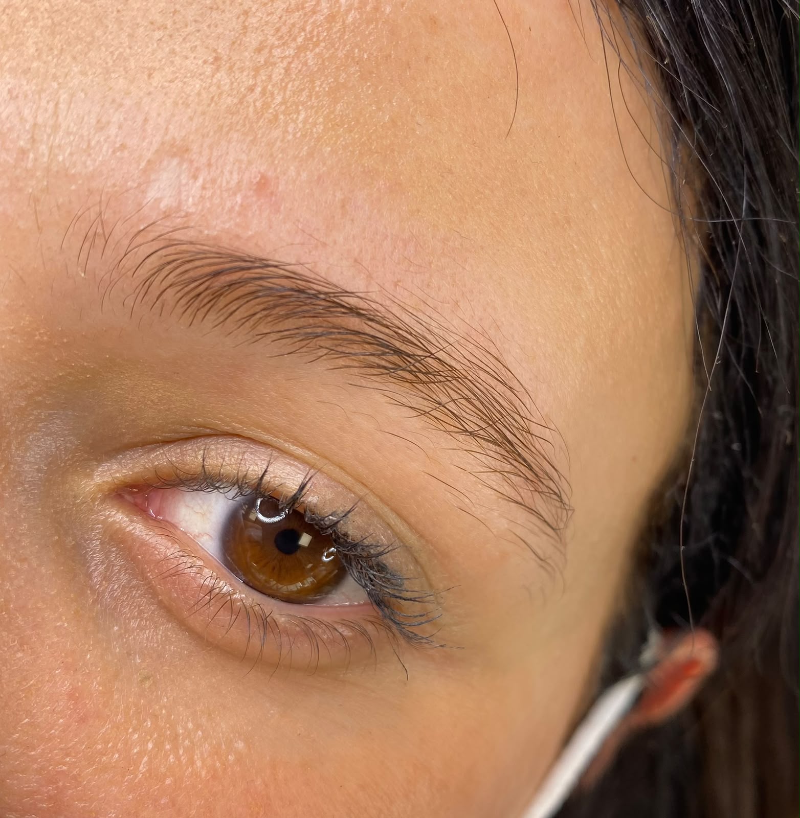 Epilazione laser gambe — prima