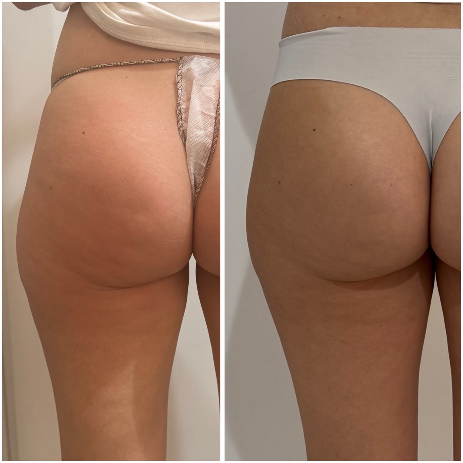 Trattamento glutei tonificazione prima e dopo