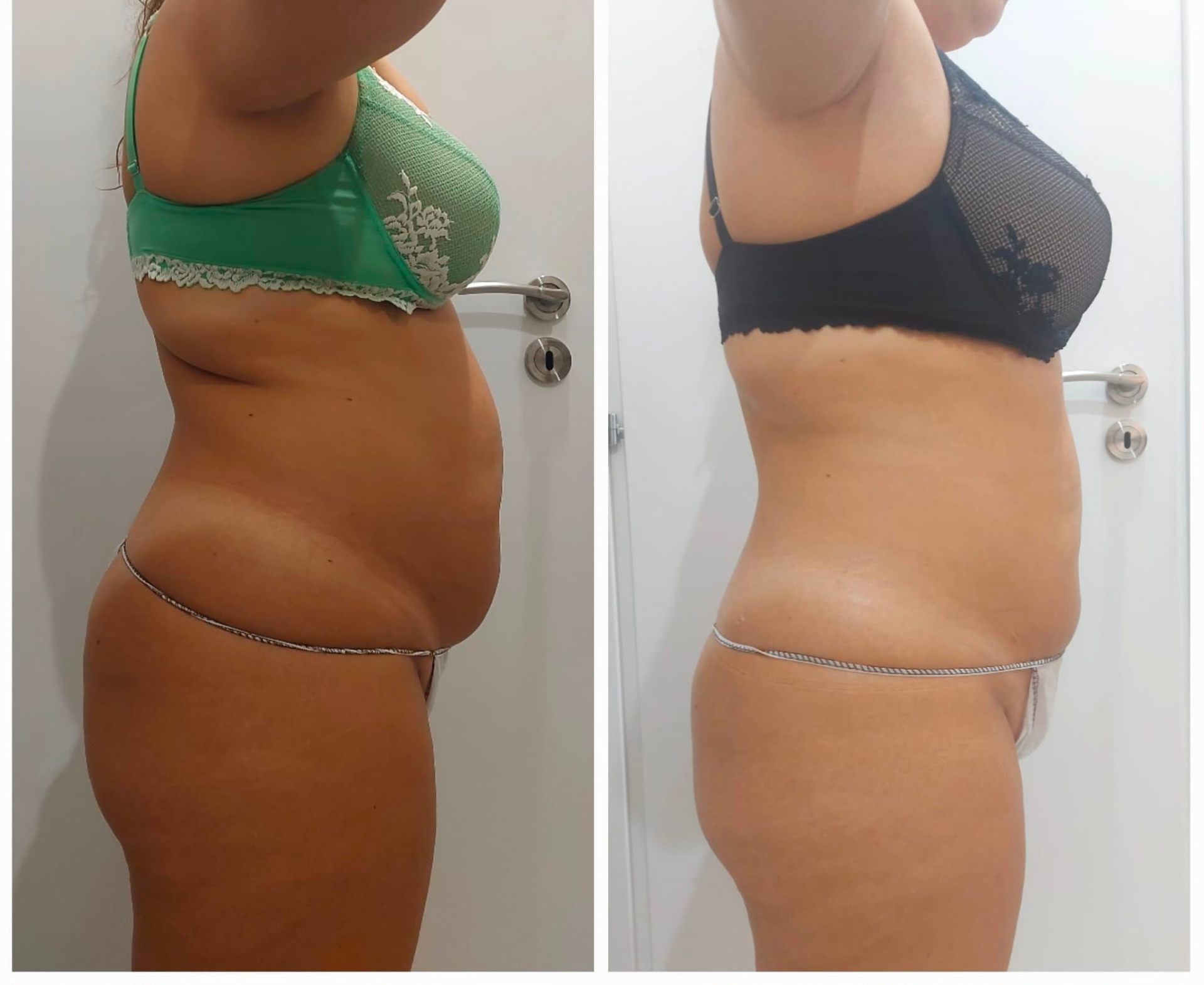 Rimodellamento corpo addome prima e dopo